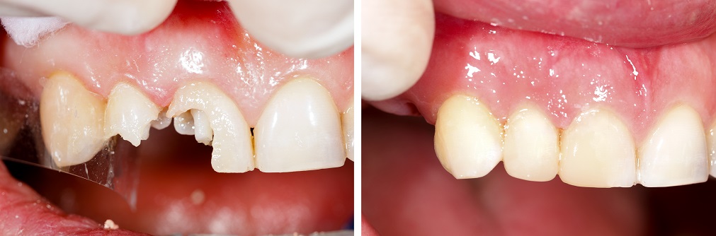 tooth crown before and after results 